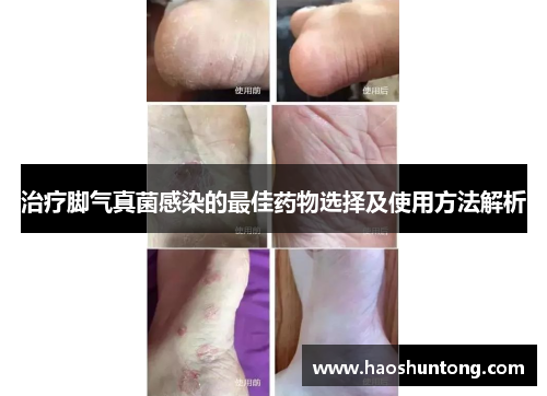 治疗脚气真菌感染的最佳药物选择及使用方法解析